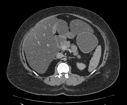 Bowel and splenic infarcts in acute lymphocytic leukemia (Radiopaedia 61055-68913 A 51).jpg