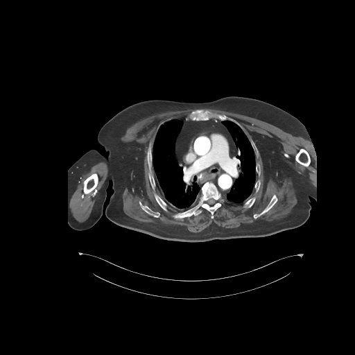File:Bowel ischemia secondary to SMA occlusion with extensive portomesenteric venous gas (Radiopaedia 54656-60871 A 85).jpg