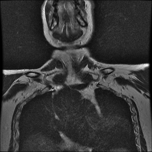 File:Brachial plexus neurofibroma (Radiopaedia 28030-28291 Coronal T2 14).png
