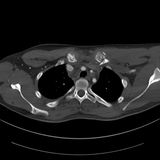 File:Brachiocephalic trunk pseudoaneurysm (Radiopaedia 70978-81191 Axial bone window 56).jpg