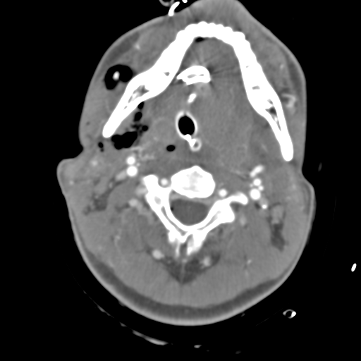 Brain contusions, internal carotid artery dissection and base of skull fracture (Radiopaedia 34089-35339 D 63).png