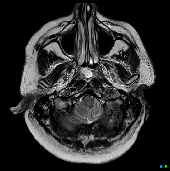 File:Brain death on MRI and CT angiography (Radiopaedia 42560-45689 Axial T2 5).jpg
