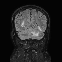 Brain metastases from lung cancer (Radiopaedia 83839-99028 Coronal FLAIR 60).jpg