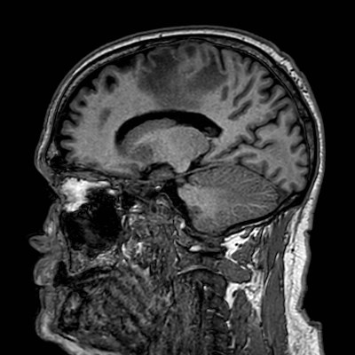 Brain metastases from lung cancer (Radiopaedia 83839-99028 Sagittal T1 78).jpg