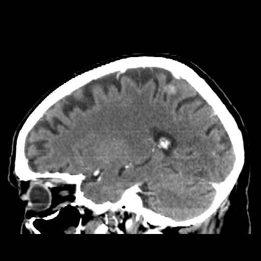 Brain metastasis (Radiopaedia 42617-45760 D 16).jpg