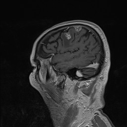 Brain metastasis (Radiopaedia 42617-45761 Sagittal T1 C+ 19).jpg