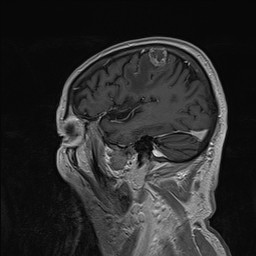 Brain metastasis (Radiopaedia 42617-45761 Sagittal T1 C+ 23).jpg