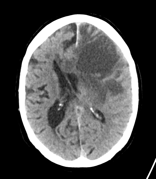 File:Brain metastasis (lung cancer) (Radiopaedia 48289-53177 Axial non-contrast 19).png