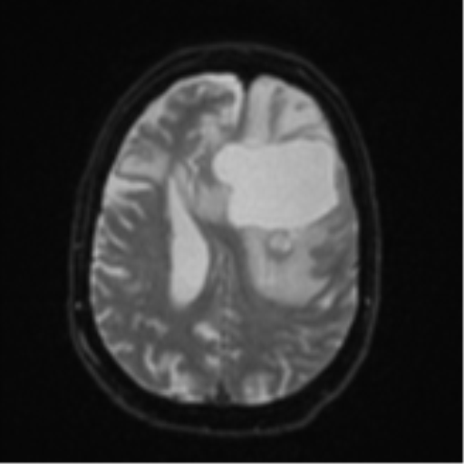 Brain metastasis (lung cancer) (Radiopaedia 48289-53179 Axial DWI 19).png