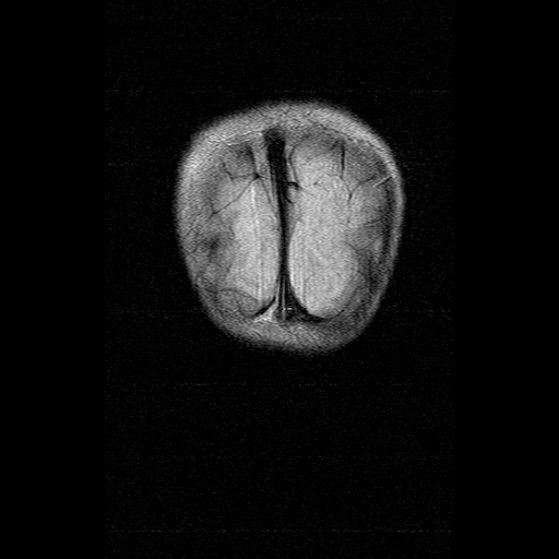 File:Brainstem ganglioglioma (Radiopaedia 10763-11224 Coronal FLAIR 1).jpg