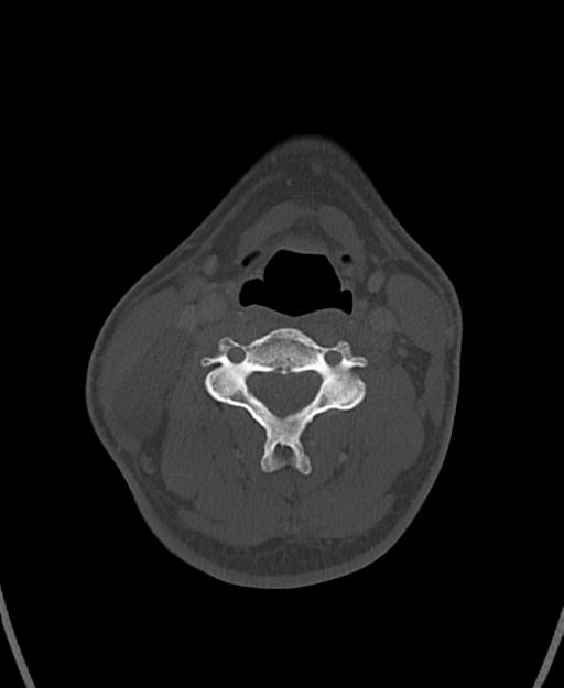 Branchial cleft cyst (Radiopaedia 31167-31875 Axial bone window 40).jpg