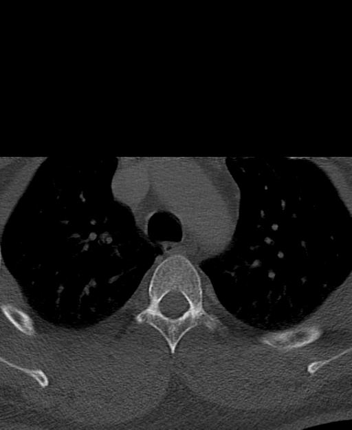 Branchial cleft cyst (Radiopaedia 31167-31875 Axial bone window 83).jpg