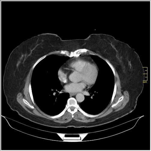 Breast cancer on thorax CT (Radiopaedia 60571-68275 A 60).JPG