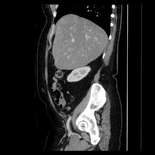 Breast cancer pseudocirrhosis with lobar invovlement (Radiopaedia 81080-94670 D 85).jpg