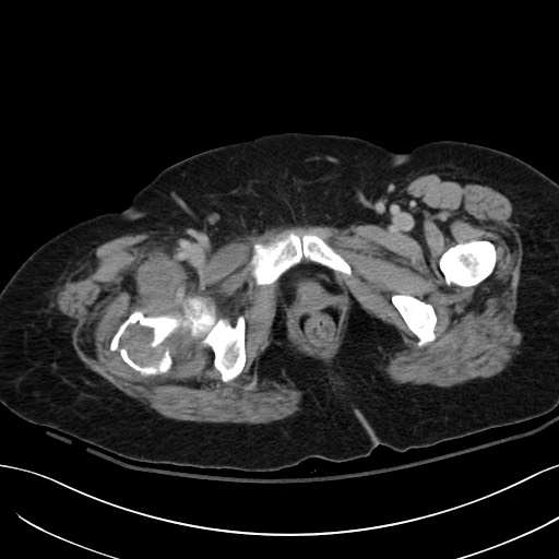 Breast carcinoma with pathological hip fracture (Radiopaedia 60314-67974 B 74).jpg
