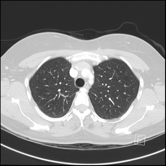 Breast metastases from renal cell cancer (Radiopaedia 79220-92225 Axial lung window 20).jpg
