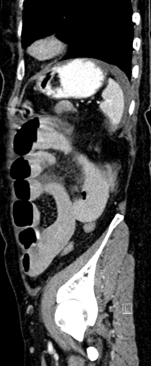 Broad ligament hernia (Radiopaedia 84802-100276 C 12).jpg