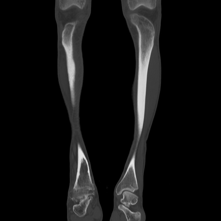 Brodie abscess - tibia (Radiopaedia 66028-75204 Coronal bone window 5).jpg