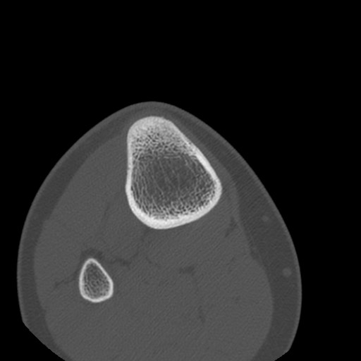 Brodie abscess of the tibia (Radiopaedia 58984-66250 Axial bone window 92).jpg