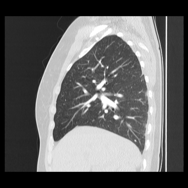 Bronchial atresia (Radiopaedia 22965-22992 Sagittal lung window 38).jpg