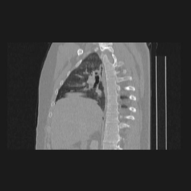 Bronchial atresia (Radiopaedia 60685-68439 Sagittal lung window 35).jpg