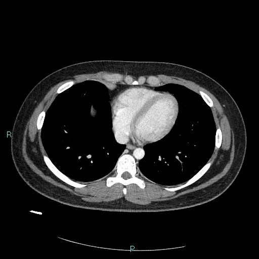Bronchial carcinoid tumor (Radiopaedia 78272-90875 A 67).jpg