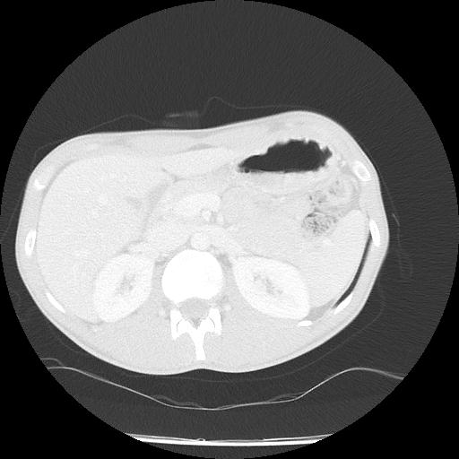 Bronchial carcinoid tumor causing right lower lobe collapse (Radiopaedia 83495-98594 Axial lung window 59).jpg