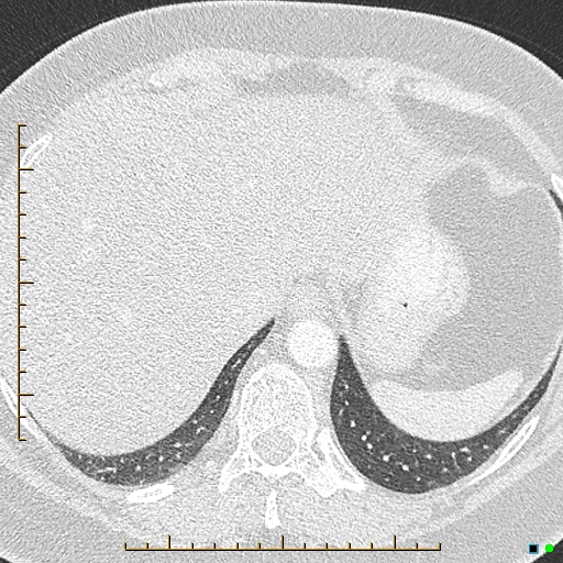Bronchial diverticula (Radiopaedia 79512-92676 Axial lung window 184).jpg