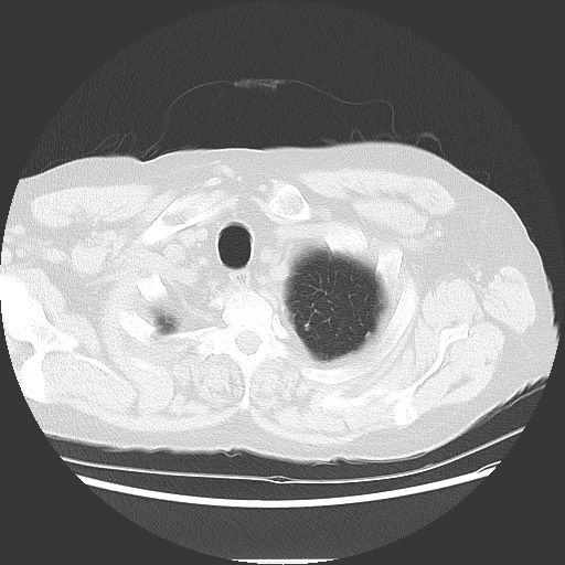 Bronchial stenosis - lung transplant (Radiopaedia 73133-83848 Axial lung window 8).jpg