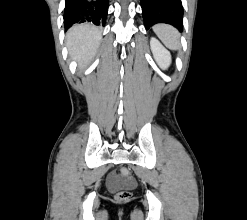 Bronchiectasis in Crohn disease (Radiopaedia 60311-67977 C 73).jpg