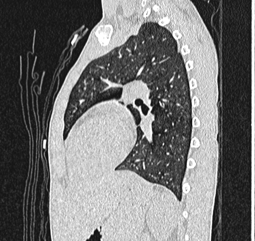 Bronchiolitis obliterans (Radiopaedia 71538-81897 Sagittal lung window 44).jpg