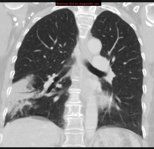 Bronchoalveolar carcinoma (BAC) (Radiopaedia 13436-13392 Coronal lung window 34).jpg