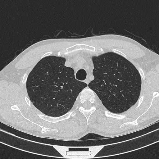 Bronchocele (Radiopaedia 60676-68429 Axial lung window 15).jpg