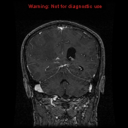 File:Bronchogenic carcinoma brain metastasis (Radiopaedia 9286-9969 Coronal T1 3).jpg