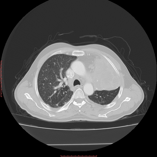 File:Bronchogenic carcinoma with left atrial large deposit - T4N3M1a (Radiopaedia 42316-45428 Axial lung window 11).jpg
