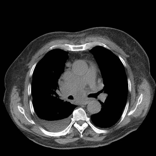 Bronchogenic carcinoma with metastatic lymphadenopathy (Radiopaedia 37671-39569 Axial non-contrast 26).jpg