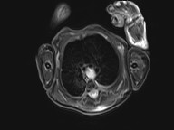 File:Bronchogenic cyst (Radiopaedia 27207-27380 Axial STIR 9).jpg