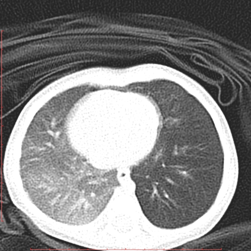 Bronchogenic cyst (Radiopaedia 78599-91409 Axial lung window 101).jpg