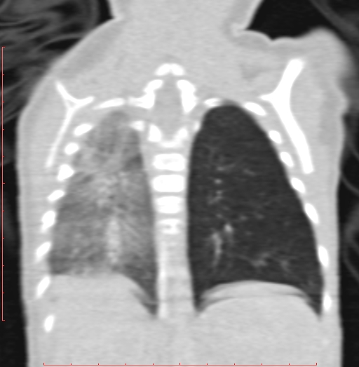 Bronchogenic cyst (Radiopaedia 78599-91409 Coronal lung window 167).jpg