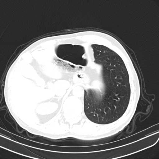 Bronchopleural fistula - postoperative complication (Radiopaedia 21020-20947 Axial lung window 51).jpg