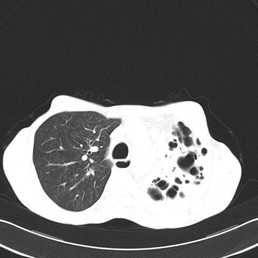 Bronchopleural fistula secondary to tuberculosis (Radiopaedia 20415-20322 Axial lung window 21).jpg