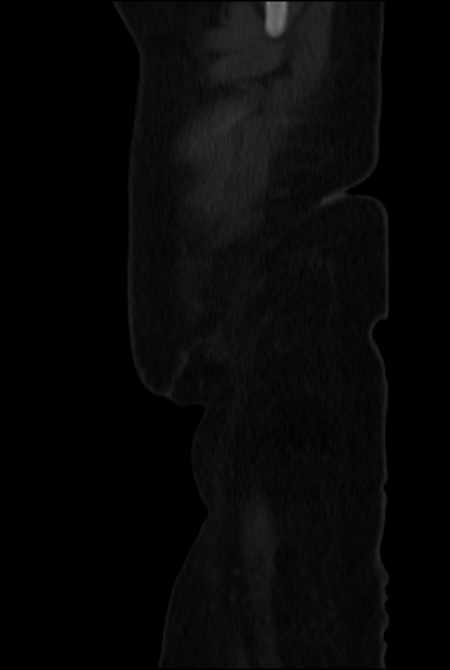 Brown tumors compressing the spinal cord (Radiopaedia 68442-77988 H 3).jpg