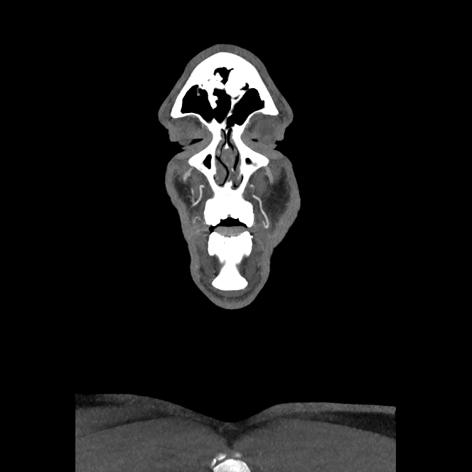 Buccal fat pad arteriovenous malformation (Radiopaedia 70936-81144 B 5).jpg