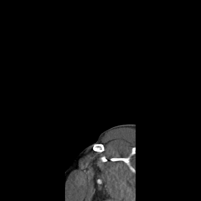 Buccal fat pad arteriovenous malformation (Radiopaedia 70936-81144 C 2).jpg