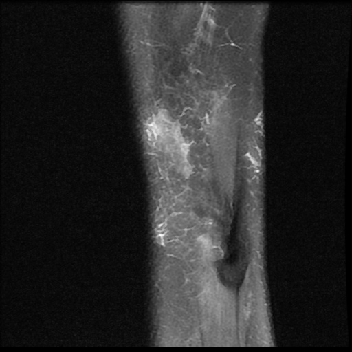 File:Bucket handle meniscus tear (Radiopaedia 56916-63751 Sagittal PD fat sat 1).jpg