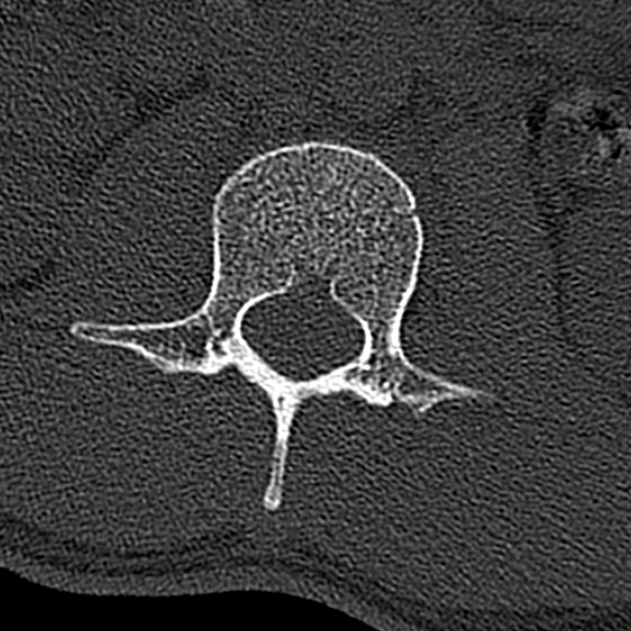 File:Burst fracture (Radiopaedia 53373-59357 Axial bone window 22).jpg