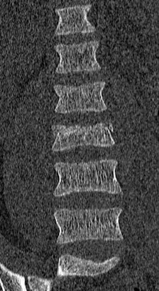 Burst fracture (Radiopaedia 53373-59357 Coronal bone window 20).jpg