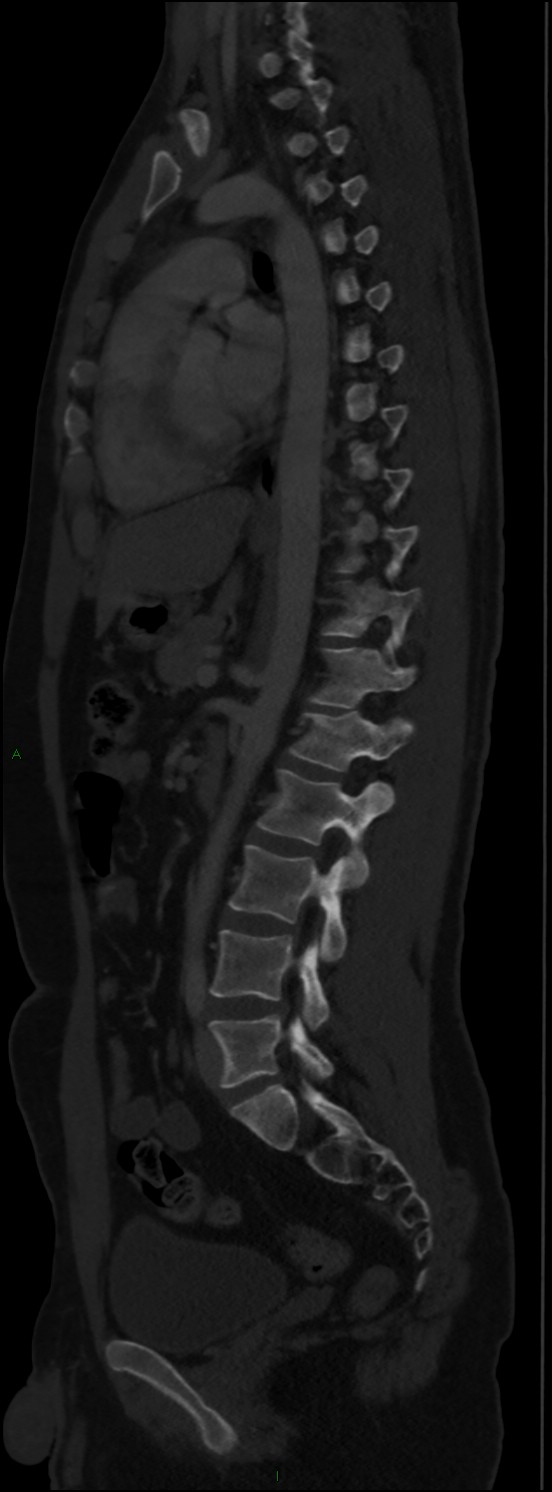 Burst fracture (Radiopaedia 83168-97542 Sagittal bone window 73).jpg