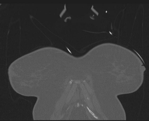 Burst fracture - thoracic spine (Radiopaedia 30238-30865 Coronal bone window 12).jpg