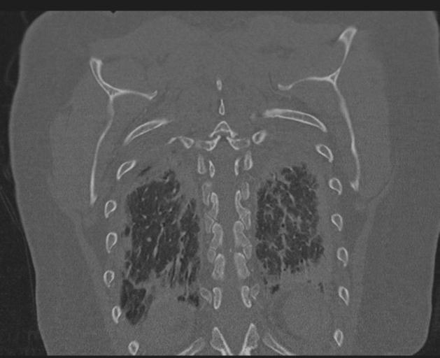 Burst fracture - thoracic spine (Radiopaedia 30238-30865 Coronal bone window 133).jpg
